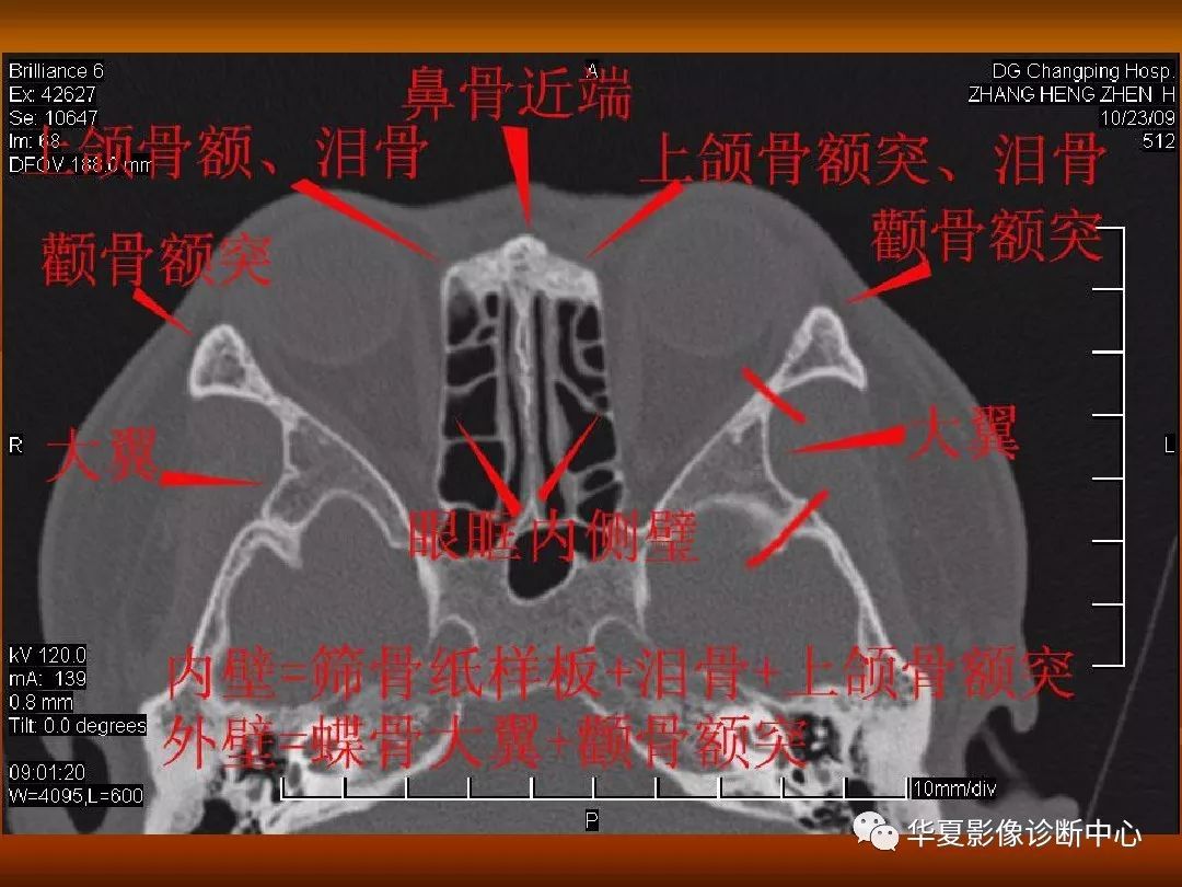 影像PPT - 【PPT】颅骨外伤性骨折CT诊断-162
