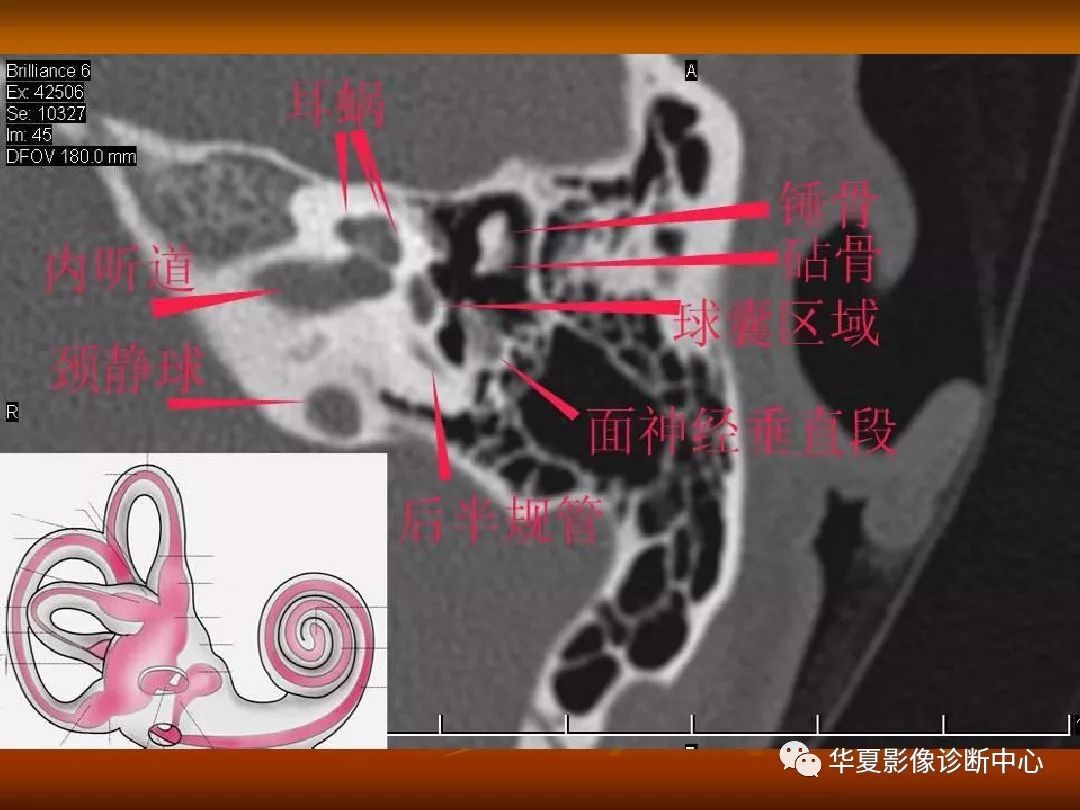 影像PPT - 【PPT】颅骨外伤性骨折CT诊断-129