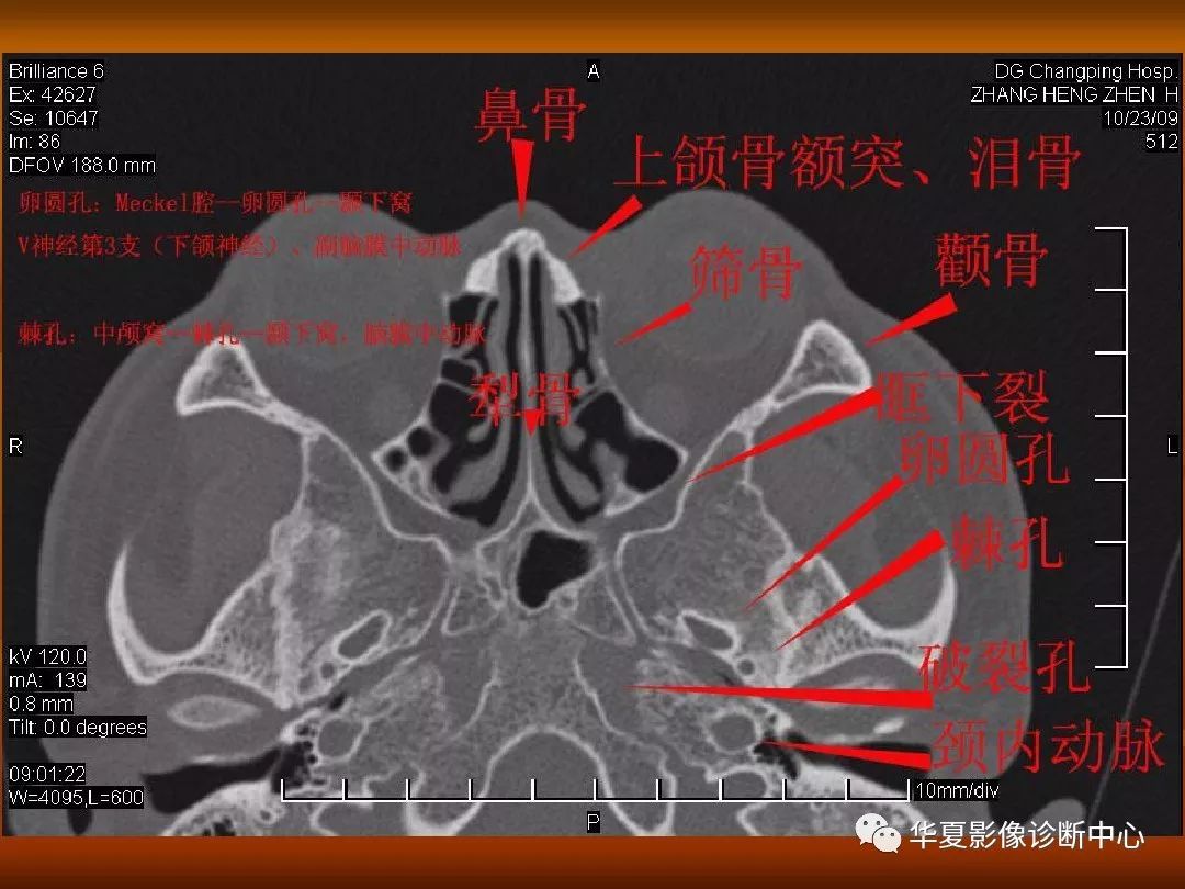 影像PPT - 【PPT】颅骨外伤性骨折CT诊断-164