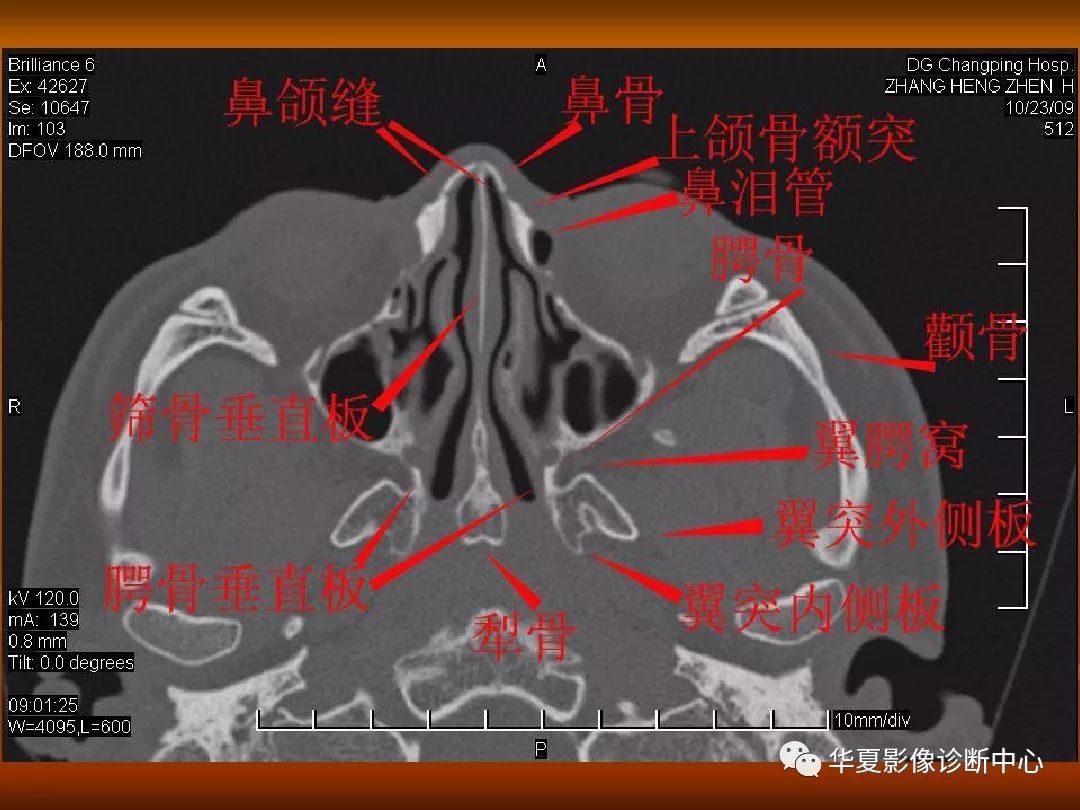 影像PPT - 【PPT】颅骨外伤性骨折CT诊断-166