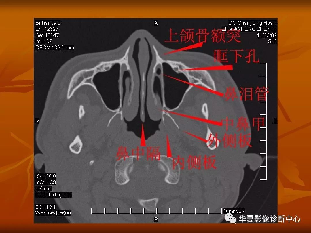 影像PPT - 【PPT】颅骨外伤性骨折CT诊断-168