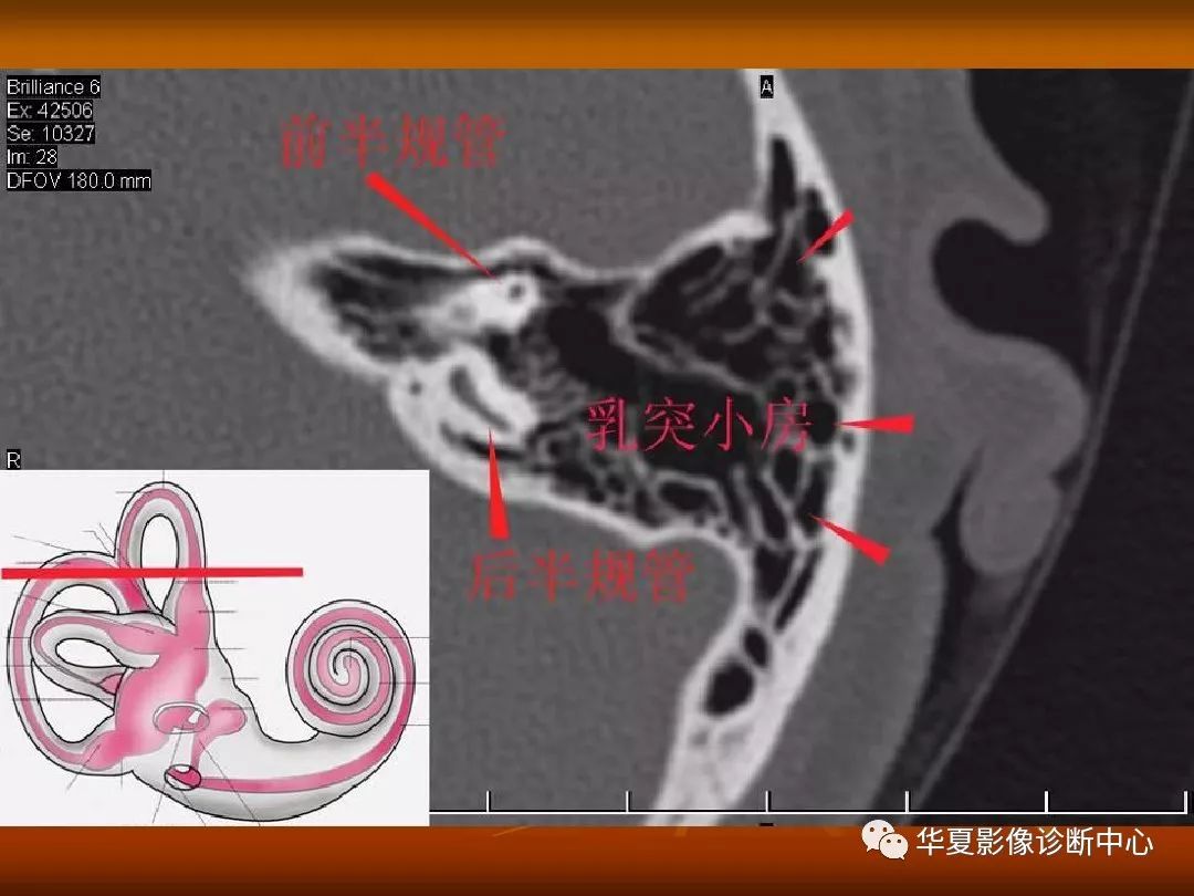 影像PPT - 【PPT】颅骨外伤性骨折CT诊断-123