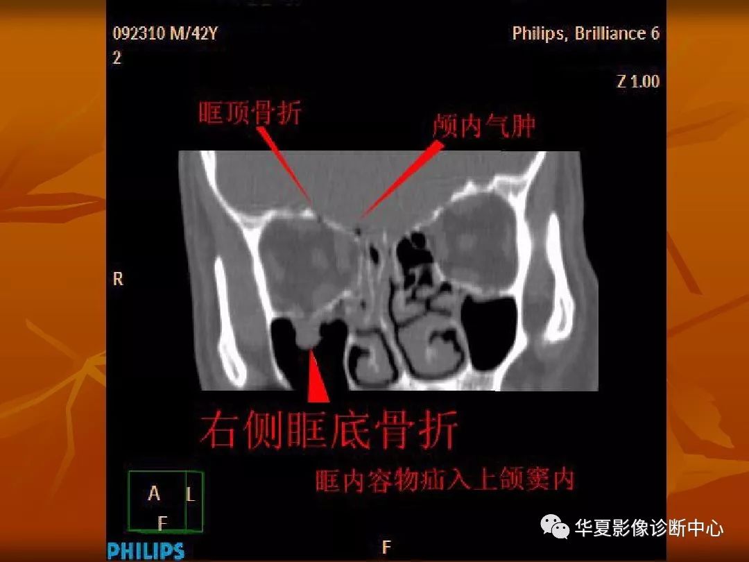 影像PPT - 【PPT】颅骨外伤性骨折CT诊断-175