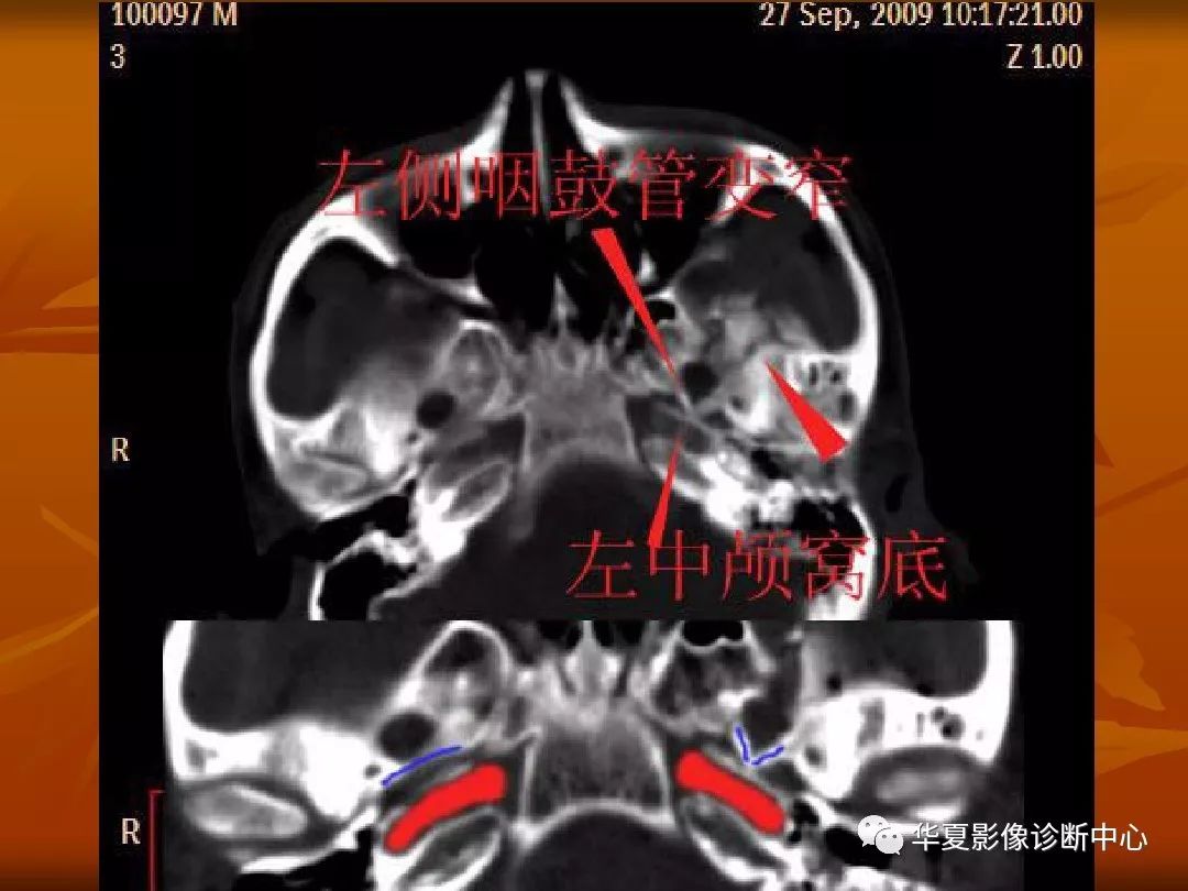 影像PPT - 【PPT】颅骨外伤性骨折CT诊断-118
