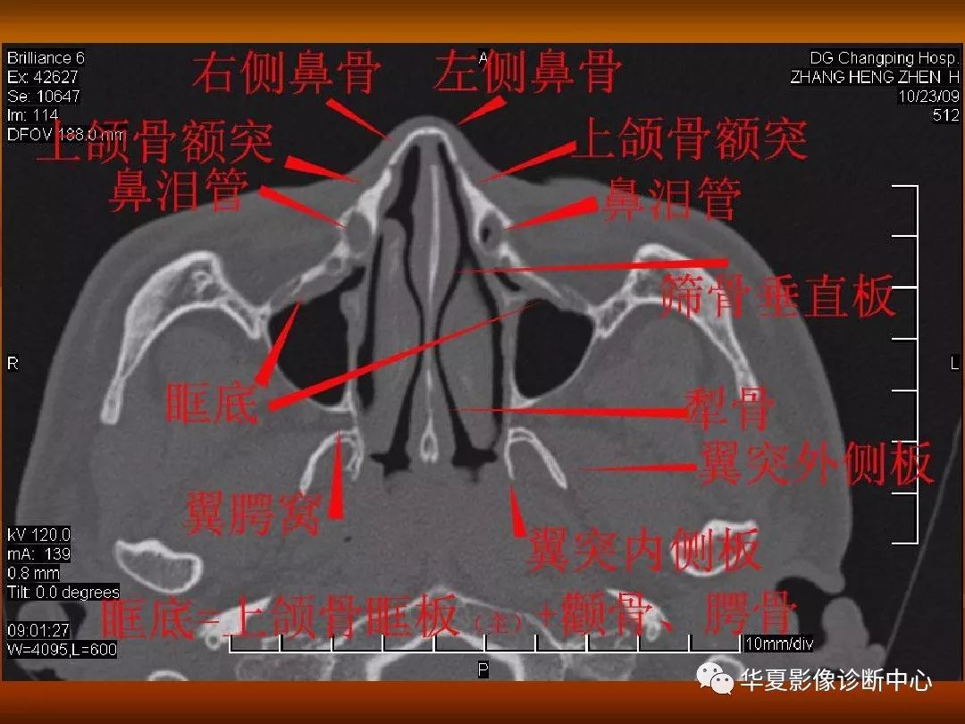 影像PPT - 【PPT】颅骨外伤性骨折CT诊断-167