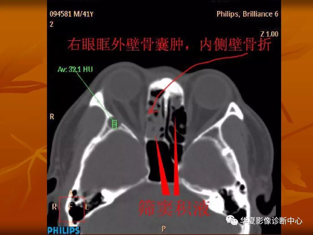 影像PPT - 【PPT】颅骨外伤性骨折CT诊断-181