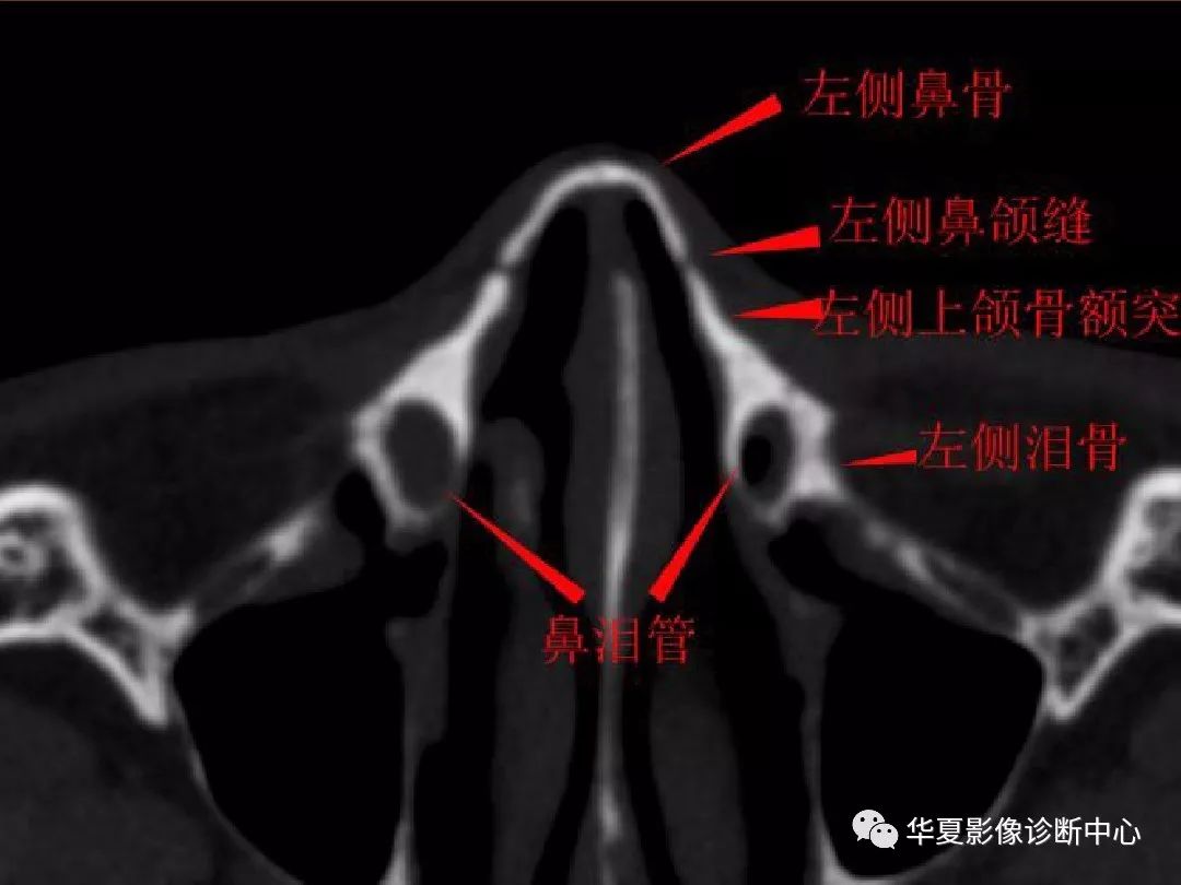 影像PPT - 【PPT】颅骨外伤性骨折CT诊断-187