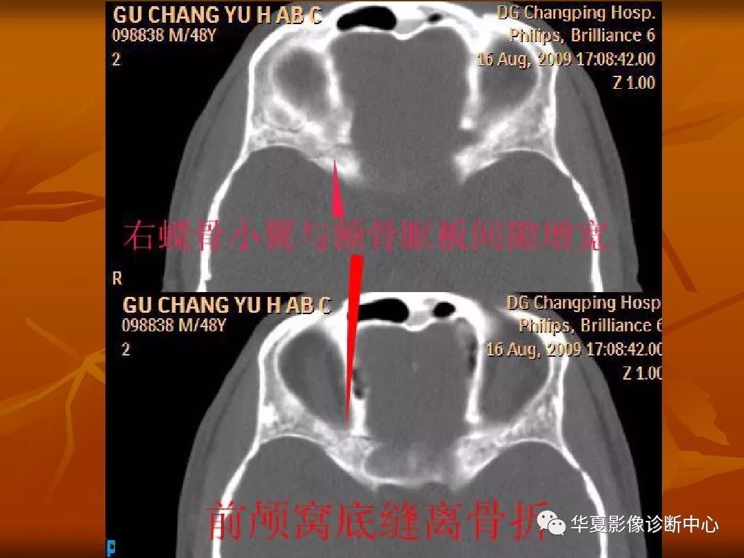 影像PPT - 【PPT】颅骨外伤性骨折CT诊断-111
