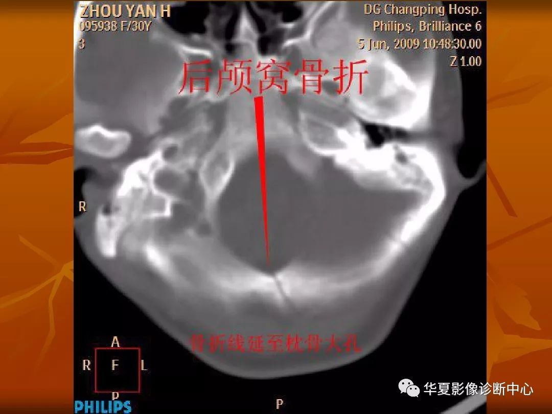 影像PPT - 【PPT】颅骨外伤性骨折CT诊断-119