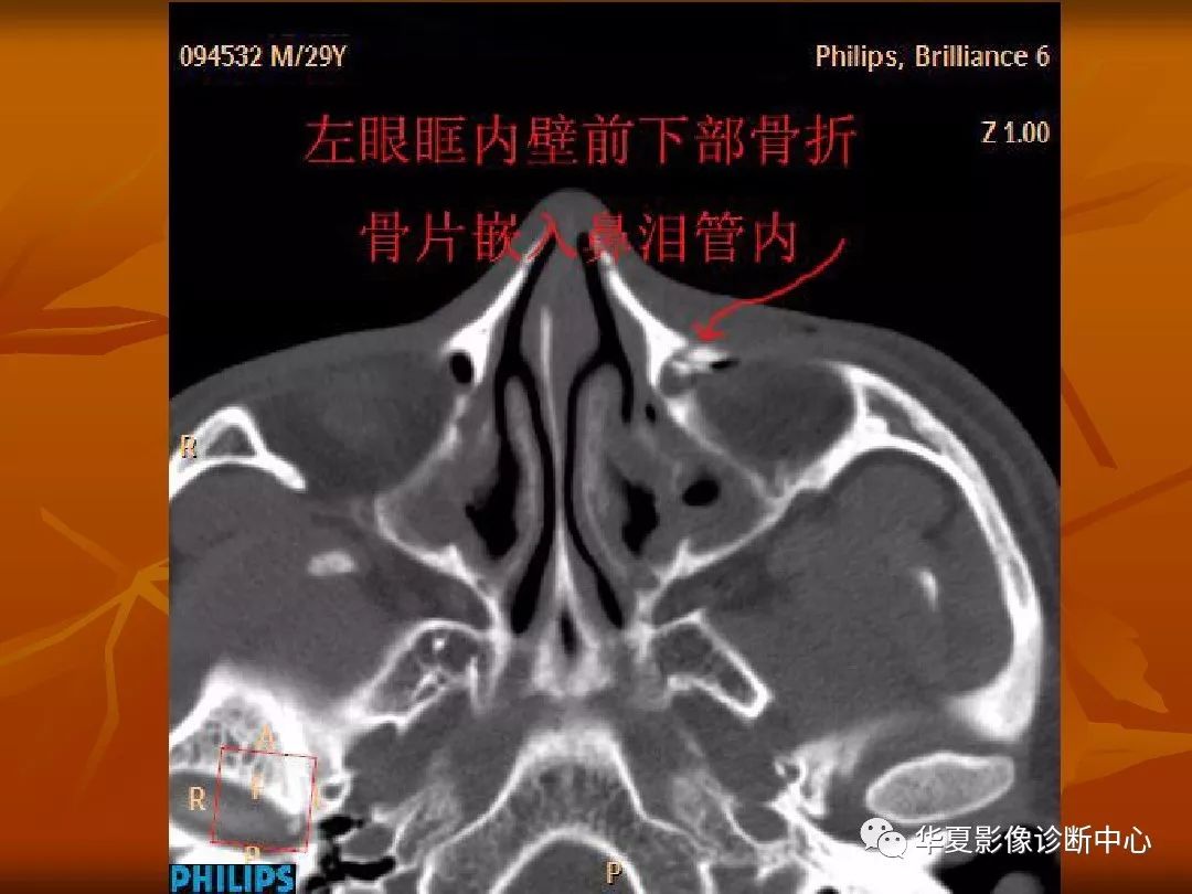 影像PPT - 【PPT】颅骨外伤性骨折CT诊断-182