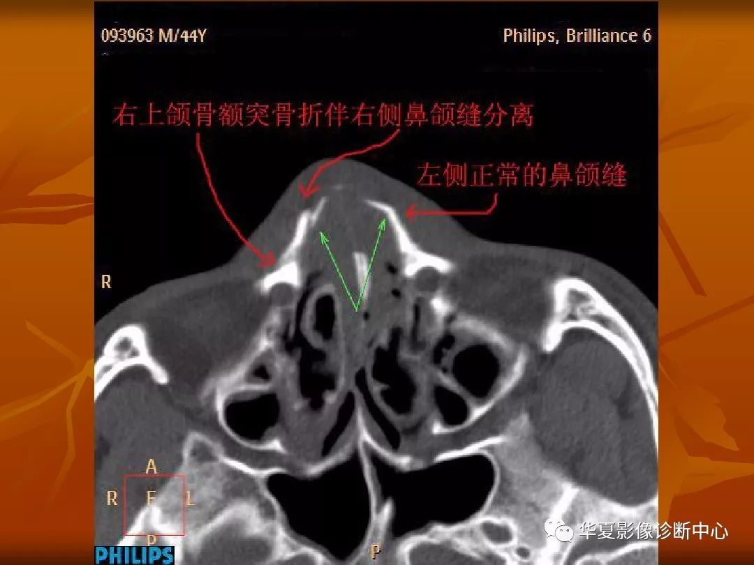 影像PPT - 【PPT】颅骨外伤性骨折CT诊断-192