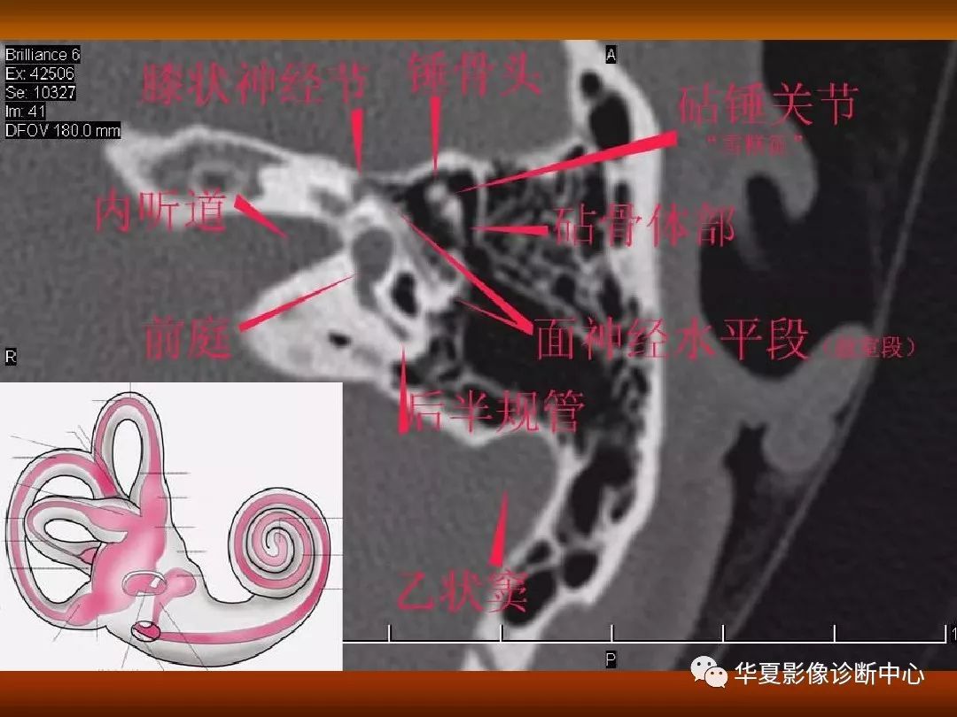 影像PPT - 【PPT】颅骨外伤性骨折CT诊断-127