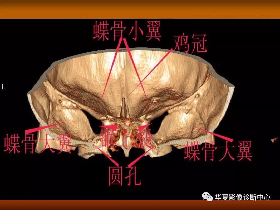 影像PPT - 【PPT】颅骨外伤性骨折CT诊断-152