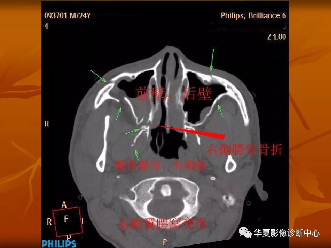 影像PPT - 【PPT】颅骨外伤性骨折CT诊断-201