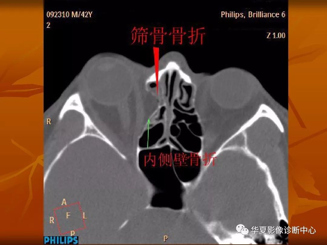 影像PPT - 【PPT】颅骨外伤性骨折CT诊断-179