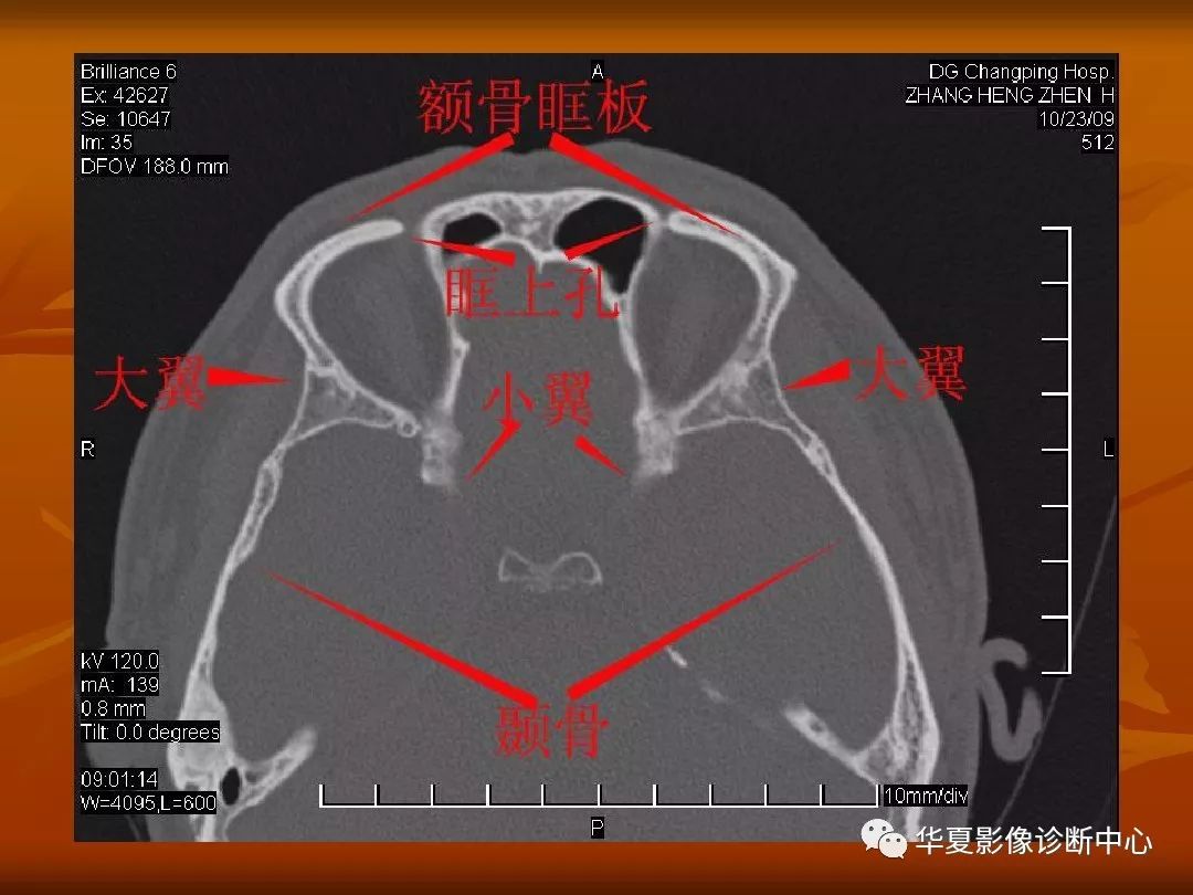 影像PPT - 【PPT】颅骨外伤性骨折CT诊断-158