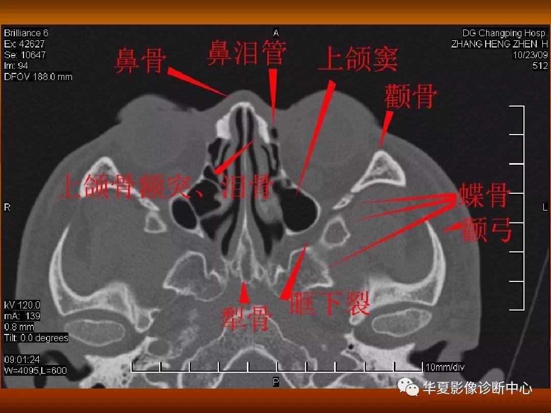 影像PPT - 【PPT】颅骨外伤性骨折CT诊断-165