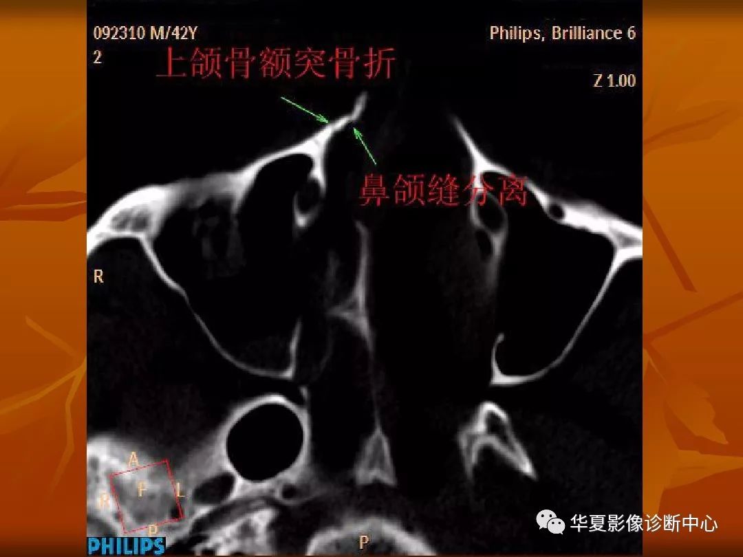 影像PPT - 【PPT】颅骨外伤性骨折CT诊断-188