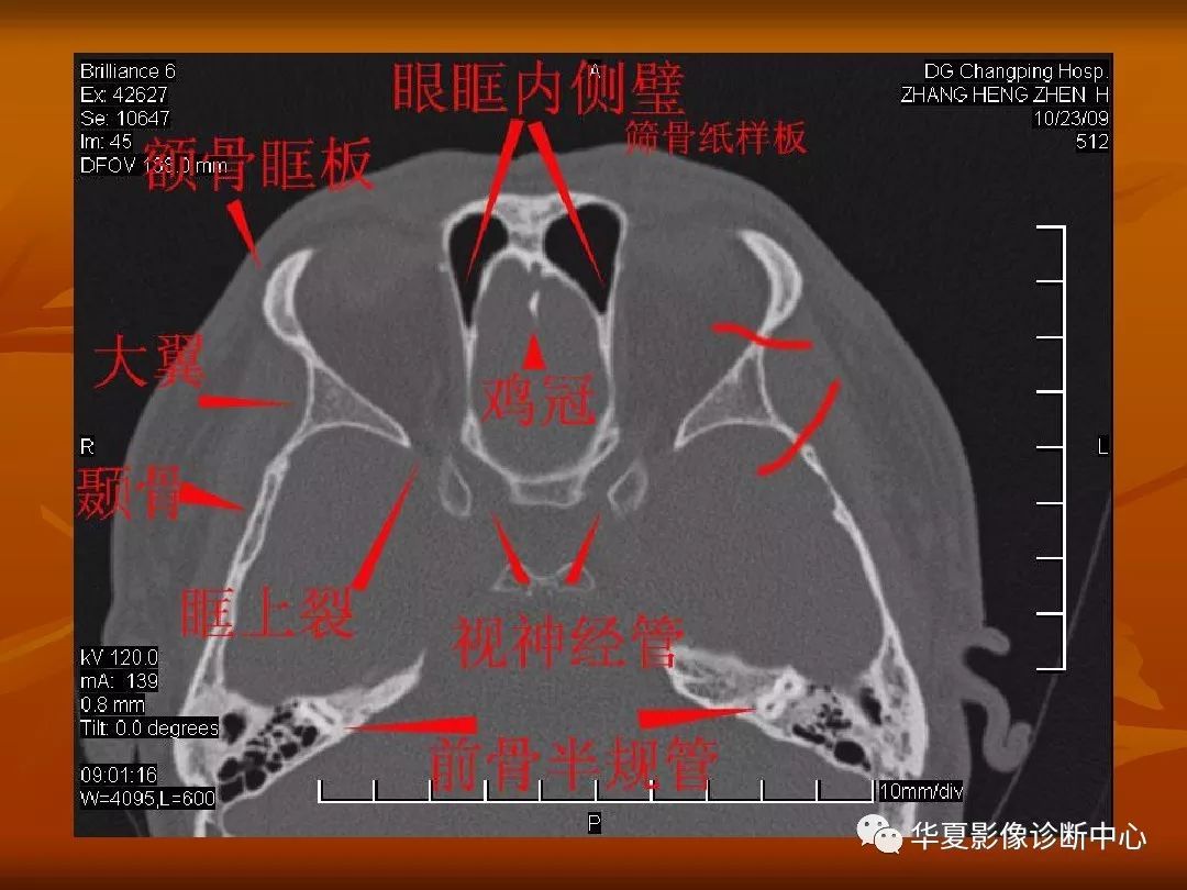 影像PPT - 【PPT】颅骨外伤性骨折CT诊断-160