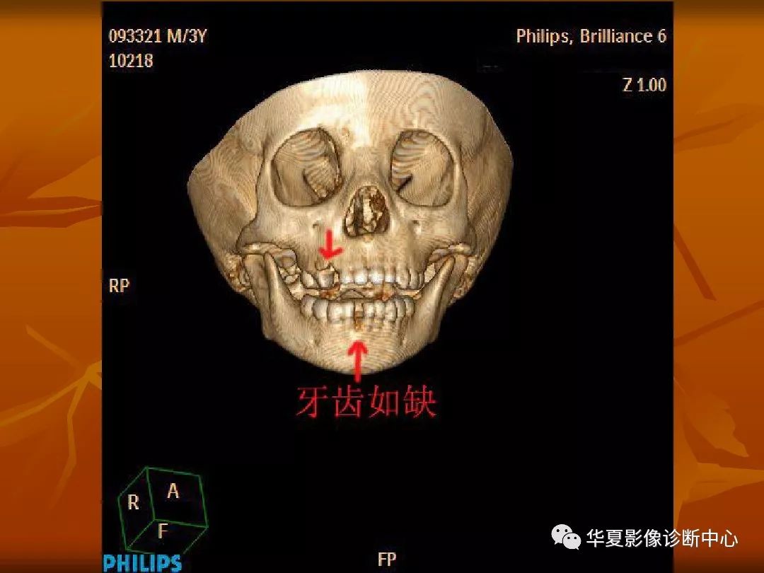 影像PPT - 【PPT】颅骨外伤性骨折CT诊断-200