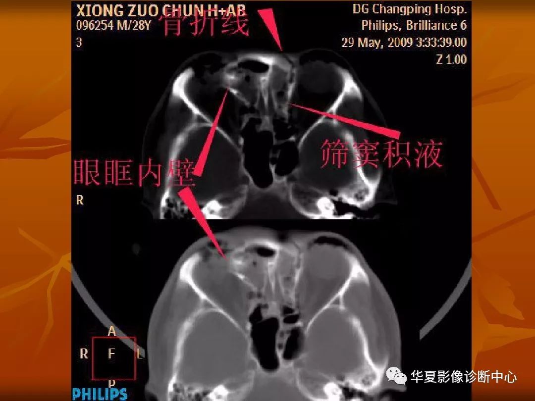 影像PPT - 【PPT】颅骨外伤性骨折CT诊断-180
