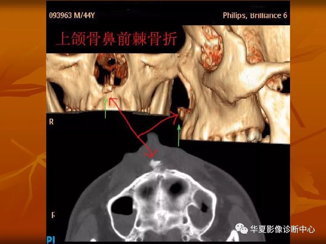 影像PPT - 【PPT】颅骨外伤性骨折CT诊断-191