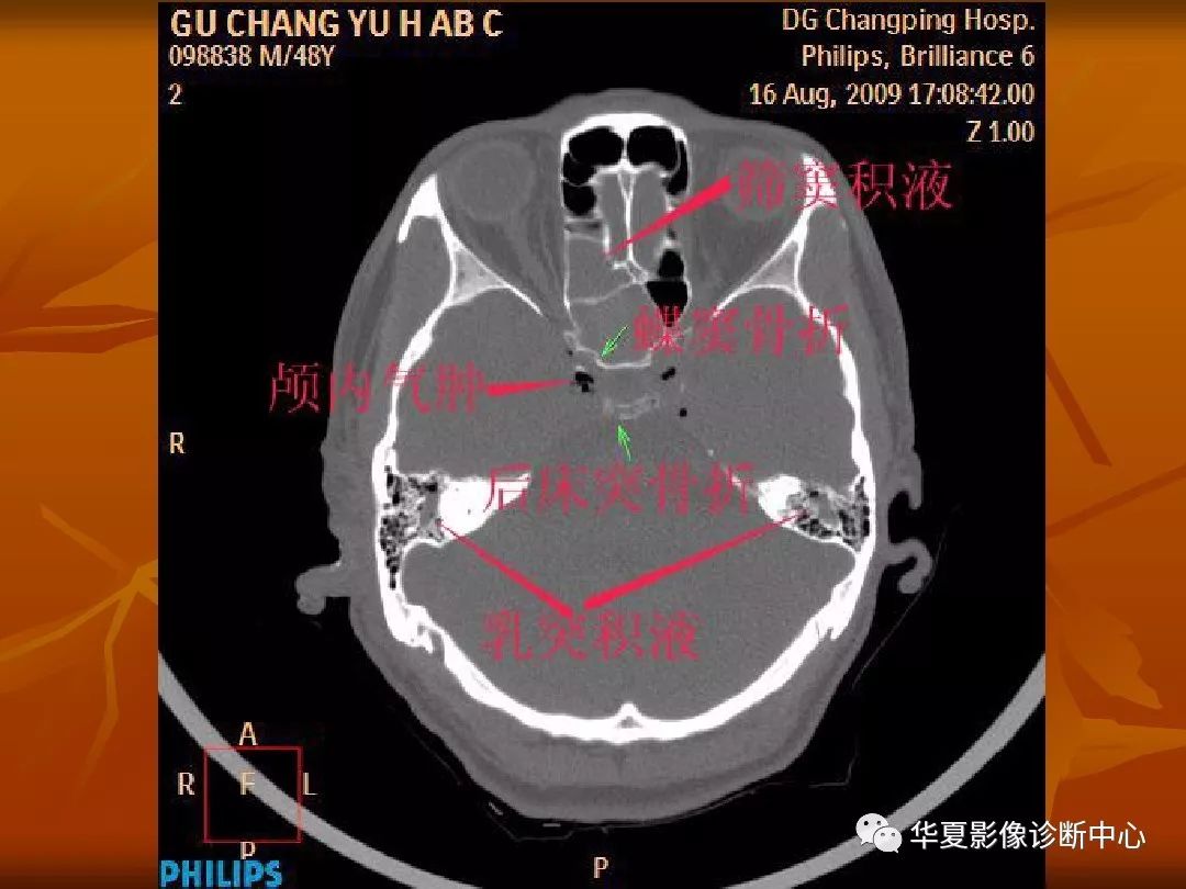 影像PPT - 【PPT】颅骨外伤性骨折CT诊断-116