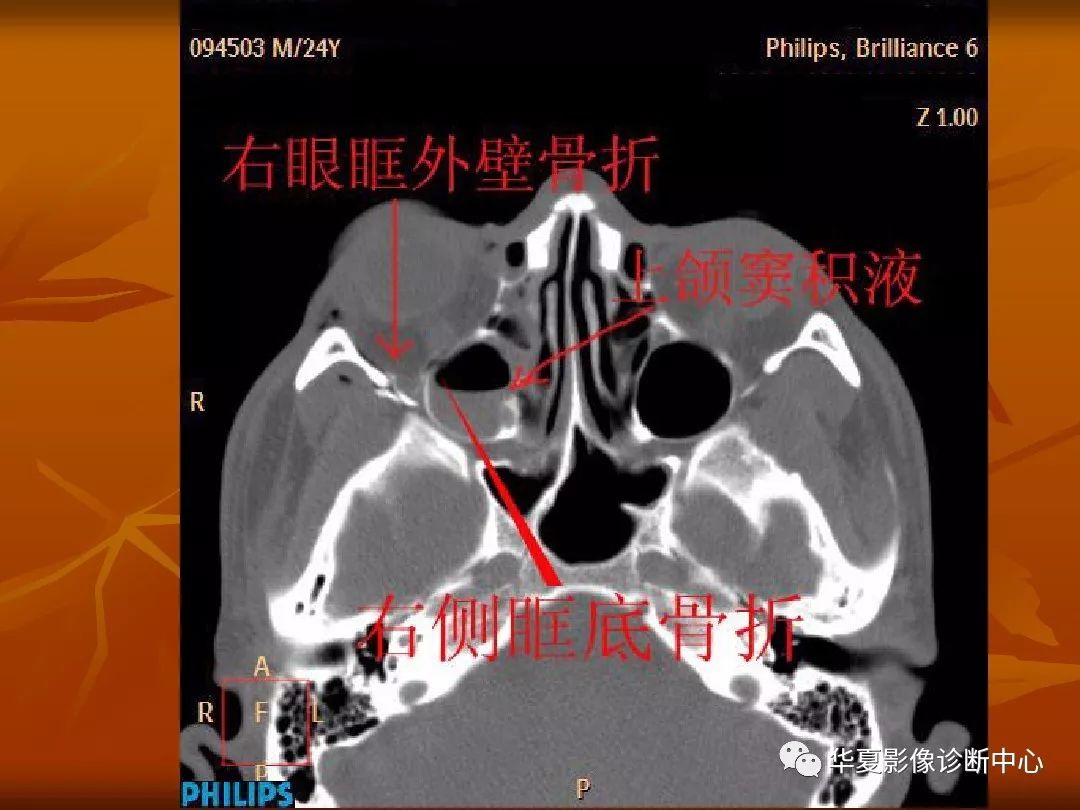 影像PPT - 【PPT】颅骨外伤性骨折CT诊断-183