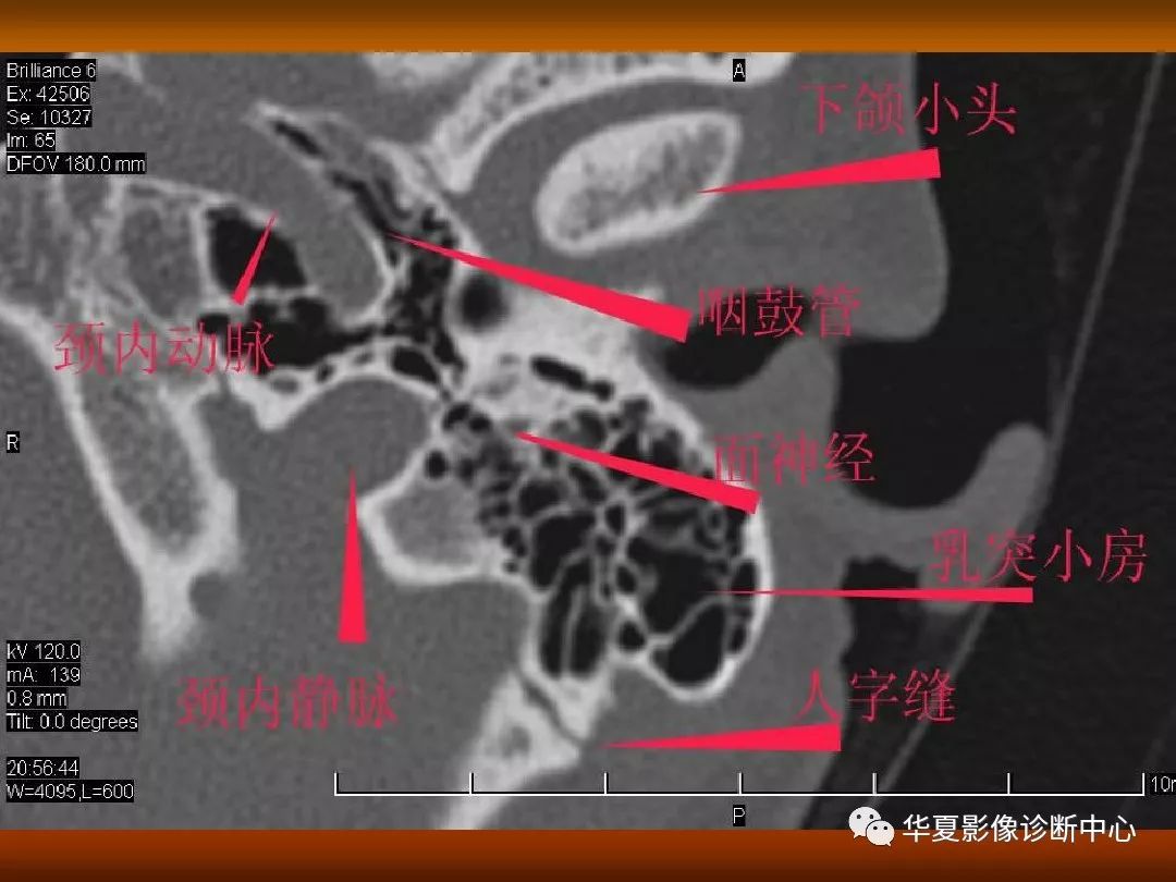 影像PPT - 【PPT】颅骨外伤性骨折CT诊断-135