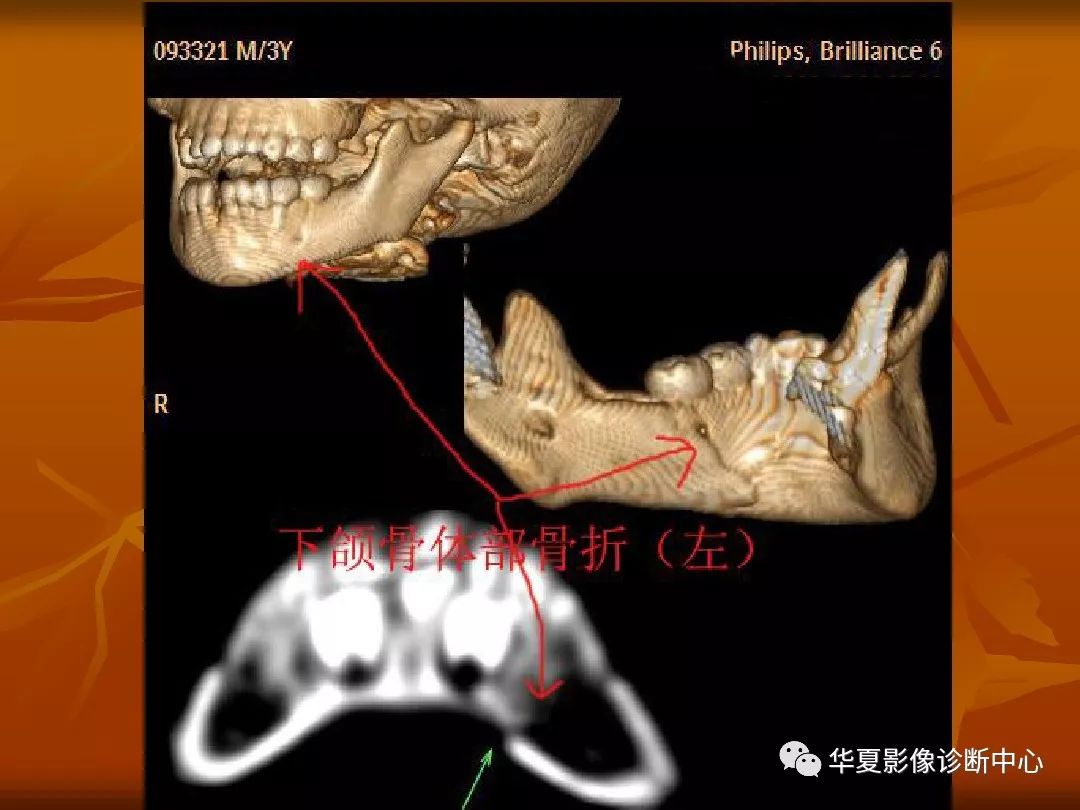 影像PPT - 【PPT】颅骨外伤性骨折CT诊断-199