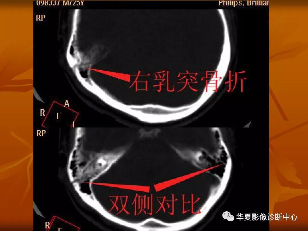 影像PPT - 【PPT】颅骨外伤性骨折CT诊断-141