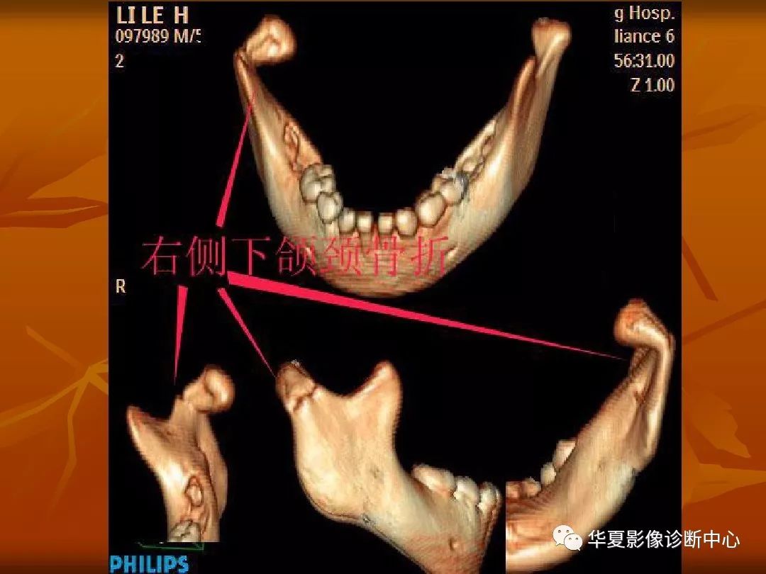 影像PPT - 【PPT】颅骨外伤性骨折CT诊断-197