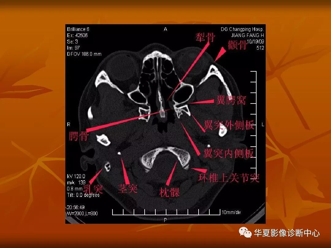 影像PPT - 【PPT】颅骨外伤性骨折CT诊断-1