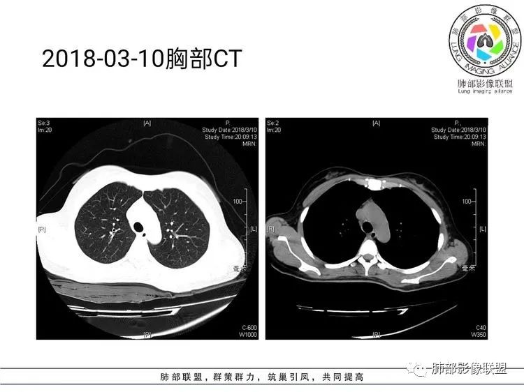 影像PPT - 【病例】难得一见的单发空洞型肺隐球菌感染-8 影像PPT - 【病例】难得一见的单发空洞型肺隐球菌感染-8