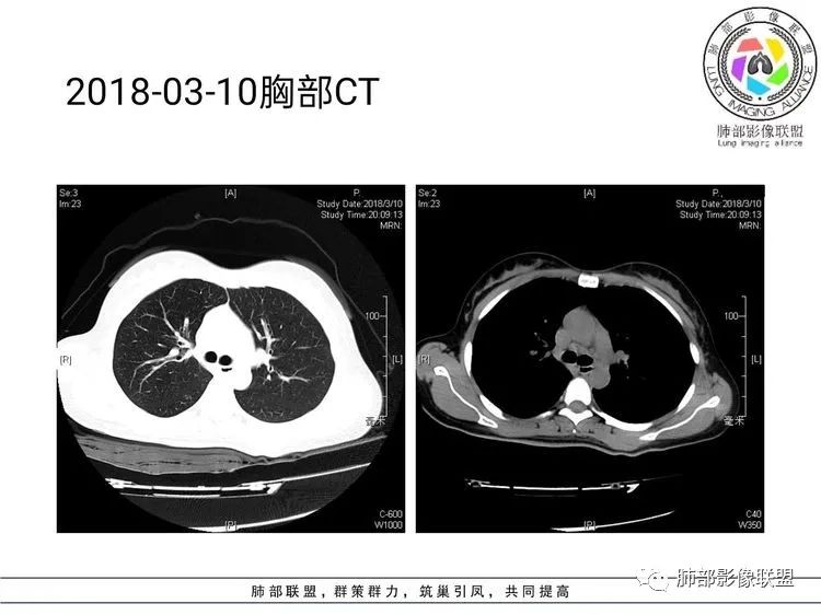 影像PPT - 【病例】难得一见的单发空洞型肺隐球菌感染-9 影像PPT - 【病例】难得一见的单发空洞型肺隐球菌感染-9