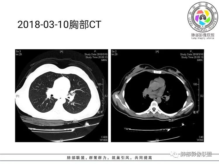 影像PPT - 【病例】难得一见的单发空洞型肺隐球菌感染-11 影像PPT - 【病例】难得一见的单发空洞型肺隐球菌感染-11