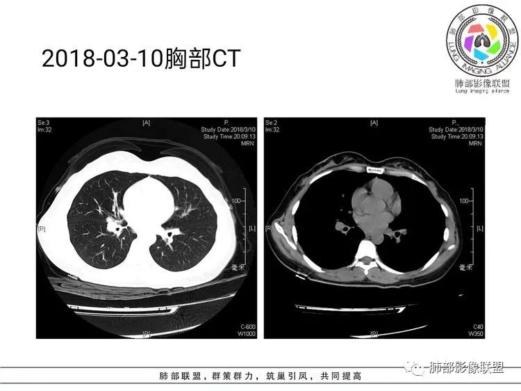 影像PPT - 【病例】难得一见的单发空洞型肺隐球菌感染-12 影像PPT - 【病例】难得一见的单发空洞型肺隐球菌感染-12