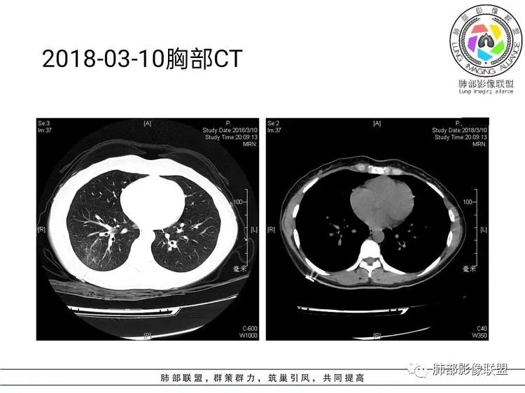 影像PPT - 【病例】难得一见的单发空洞型肺隐球菌感染-13 影像PPT - 【病例】难得一见的单发空洞型肺隐球菌感染-13