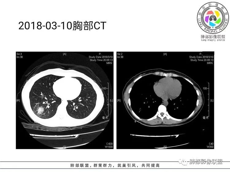 影像PPT - 【病例】难得一见的单发空洞型肺隐球菌感染-14 影像PPT - 【病例】难得一见的单发空洞型肺隐球菌感染-14