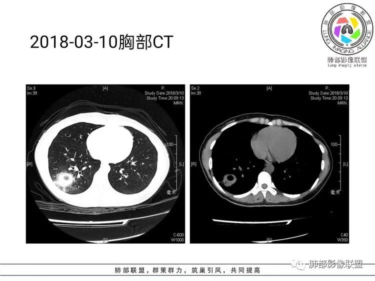 影像PPT - 【病例】难得一见的单发空洞型肺隐球菌感染-15 影像PPT - 【病例】难得一见的单发空洞型肺隐球菌感染-15