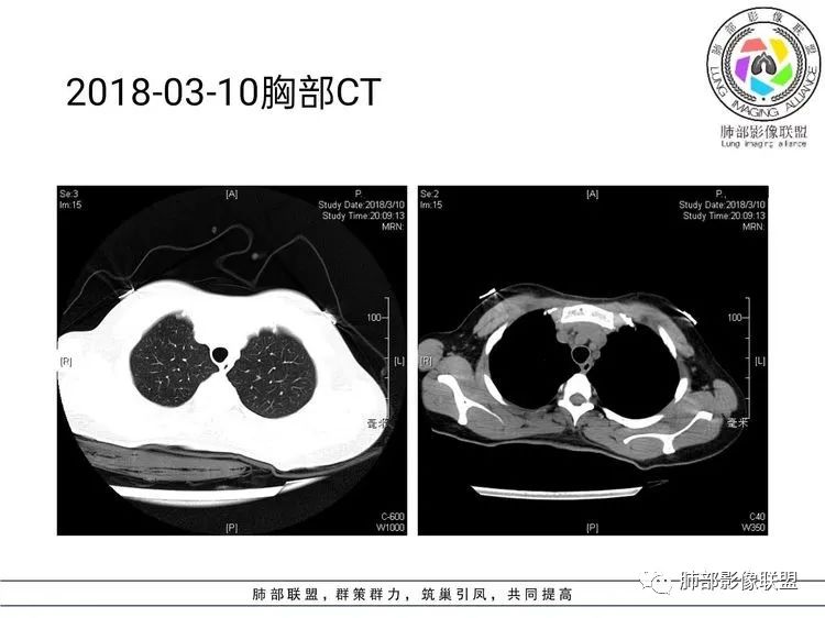 影像PPT - 【病例】难得一见的单发空洞型肺隐球菌感染-7 影像PPT - 【病例】难得一见的单发空洞型肺隐球菌感染-7