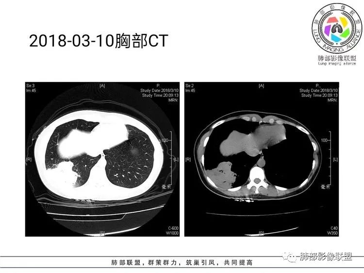 影像PPT - 【病例】难得一见的单发空洞型肺隐球菌感染-21 影像PPT - 【病例】难得一见的单发空洞型肺隐球菌感染-21