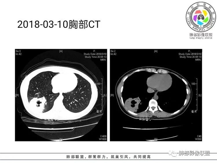 影像PPT - 【病例】难得一见的单发空洞型肺隐球菌感染-18 影像PPT - 【病例】难得一见的单发空洞型肺隐球菌感染-18