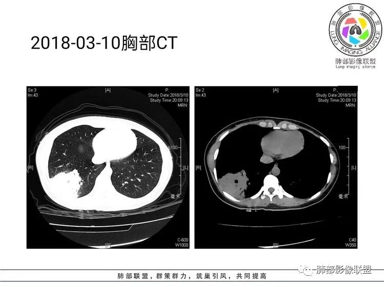影像PPT - 【病例】难得一见的单发空洞型肺隐球菌感染-19 影像PPT - 【病例】难得一见的单发空洞型肺隐球菌感染-19