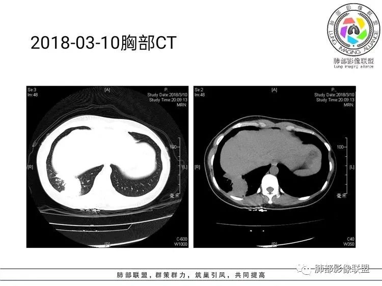 影像PPT - 【病例】难得一见的单发空洞型肺隐球菌感染-24 影像PPT - 【病例】难得一见的单发空洞型肺隐球菌感染-24