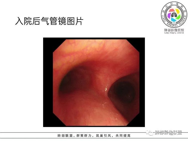 影像PPT - 【病例】难得一见的单发空洞型肺隐球菌感染-27 影像PPT - 【病例】难得一见的单发空洞型肺隐球菌感染-27