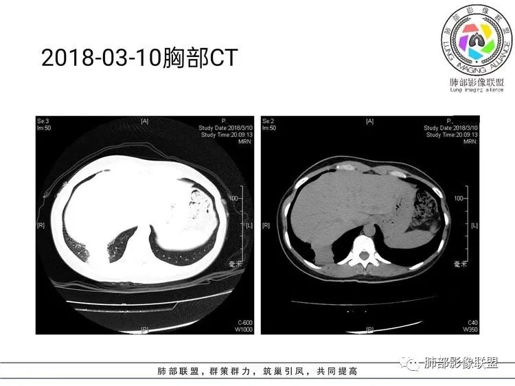 影像PPT - 【病例】难得一见的单发空洞型肺隐球菌感染-26 影像PPT - 【病例】难得一见的单发空洞型肺隐球菌感染-26