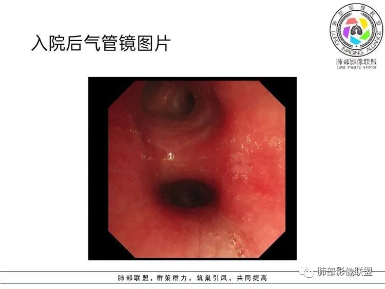 影像PPT - 【病例】难得一见的单发空洞型肺隐球菌感染-28 影像PPT - 【病例】难得一见的单发空洞型肺隐球菌感染-28