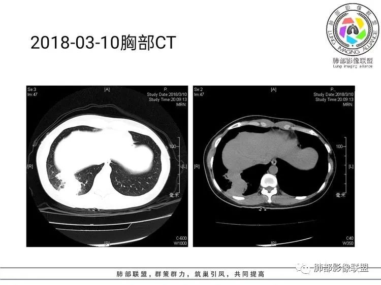 影像PPT - 【病例】难得一见的单发空洞型肺隐球菌感染-23 影像PPT - 【病例】难得一见的单发空洞型肺隐球菌感染-23