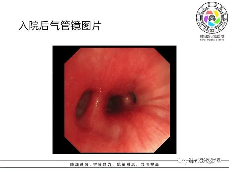影像PPT - 【病例】难得一见的单发空洞型肺隐球菌感染-29 影像PPT - 【病例】难得一见的单发空洞型肺隐球菌感染-29